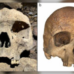 Paciente com cancro recebeu a primeira vacina mRNA contra o melanoma